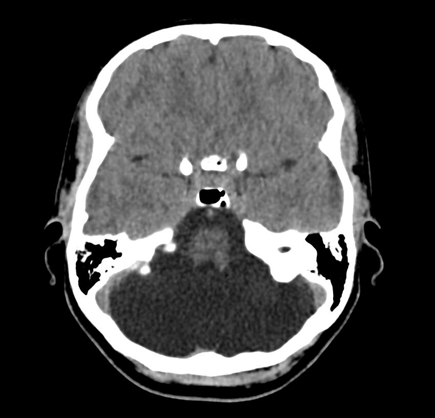 Cerebellar agenesis (Radiopaedia 30203-30817 Axial non-contrast 12).jpg