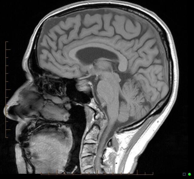 File:Cerebellar gangliocytoma (Radiopaedia 65377-74422 Sagittal T1 23).jpg