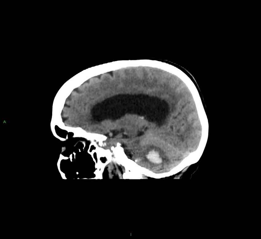 Cerebellar hemorrhage (Radiopaedia 58793-66027 C 22).jpg