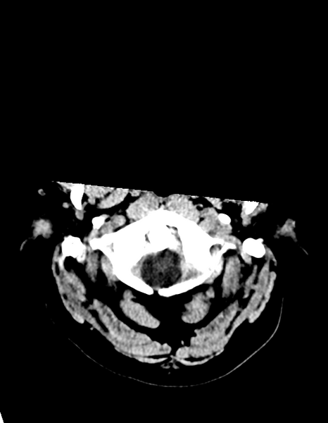 File:Cerebellar infarct due to vertebral artery dissection with posterior fossa decompression (Radiopaedia 82779-97030 Axial non-contrast 3).png