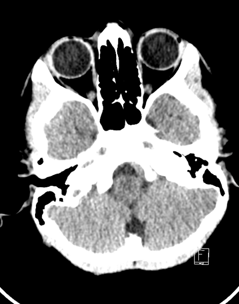 File:Cerebellar stroke (Radiopaedia 32202-33149 Axial non-contrast 2).png