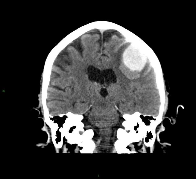 File:Cerebral amyloid angiopathy-associated lobar intracerebral hemorrhage (Radiopaedia 58376-65511 Coronal non-contrast 31).jpg