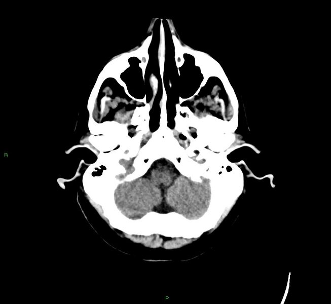 File:Cerebral amyloid angiopathy-associated lobar intracerebral hemorrhage (Radiopaedia 58529-65681 Axial non-contrast 45).jpg