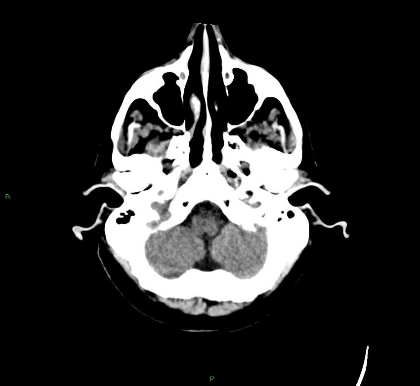 Cerebral amyloid angiopathy-associated lobar intracerebral hemorrhage (Radiopaedia 58529-65681 Axial non-contrast 45).jpg