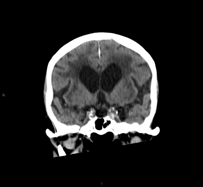 File:Cerebral amyloid angiopathy-associated lobar intracerebral hemorrhage (Radiopaedia 58530-65688 Coronal non-contrast 43).jpg