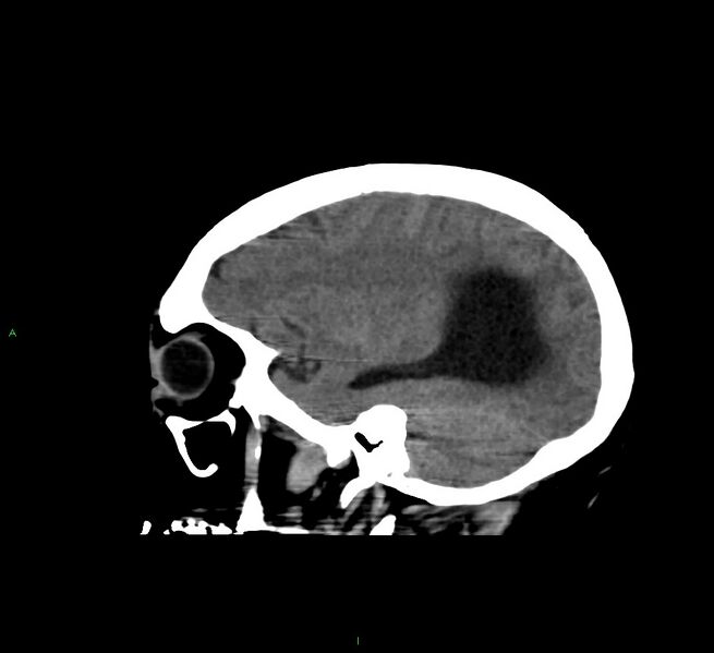 File:Cerebral amyloid angiopathy-associated lobar intracerebral hemorrhage (Radiopaedia 58560-65723 C 38).jpg