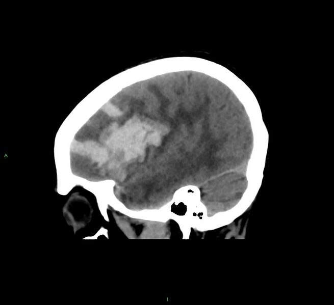 File:Cerebral amyloid angiopathy-associated lobar intracerebral hemorrhage (Radiopaedia 58561-65724 C 38).jpg