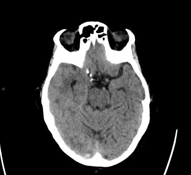 File:Cerebral amyloid angiopathy-associated lobar intracerebral hemorrhage (Radiopaedia 58563-65727 Axial non-contrast 36).jpg