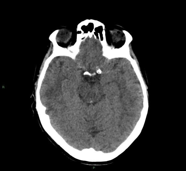 File:Cerebral amyloid angiopathy-associated lobar intracerebral hemorrhage (Radiopaedia 58566-65730 Axial non-contrast 33).jpg