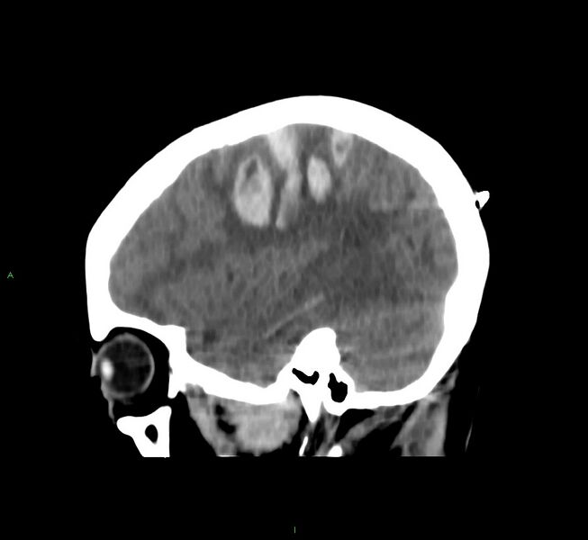 File:Cerebral amyloid angiopathy-associated lobar intracerebral hemorrhage (Radiopaedia 58566-65730 C 13).jpg