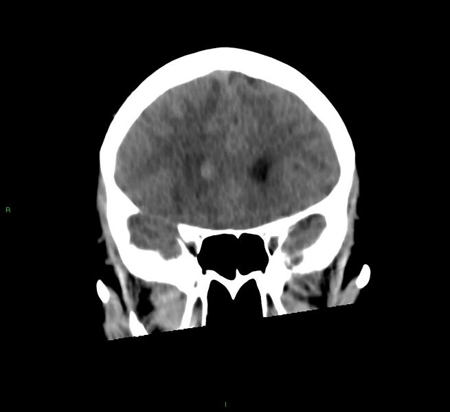 File:Cerebral amyloid angiopathy-associated lobar intracerebral hemorrhage (Radiopaedia 58566-65730 Coronal non-contrast 49).jpg