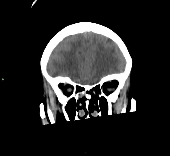 File:Cerebral amyloid angiopathy-associated lobar intracerebral hemorrhage (Radiopaedia 58566-65730 Coronal non-contrast 53).jpg