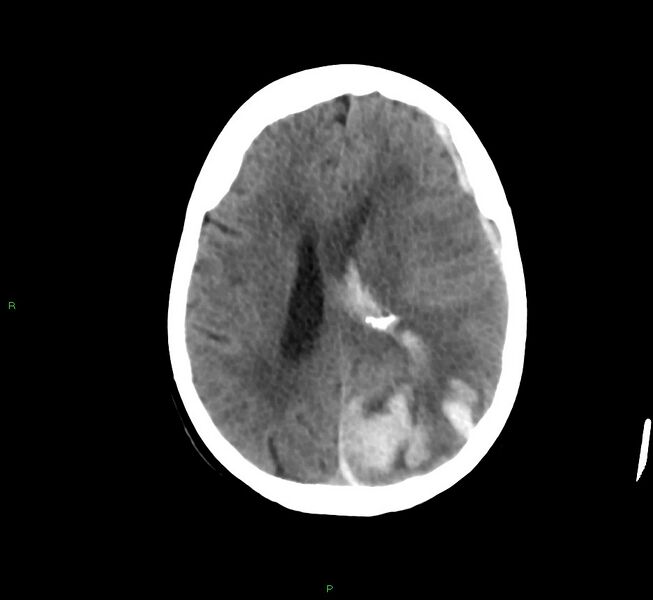 File:Cerebral amyloid angiopathy-associated lobar intracerebral hemorrhage (Radiopaedia 58754-65975 Axial non-contrast 28).jpg