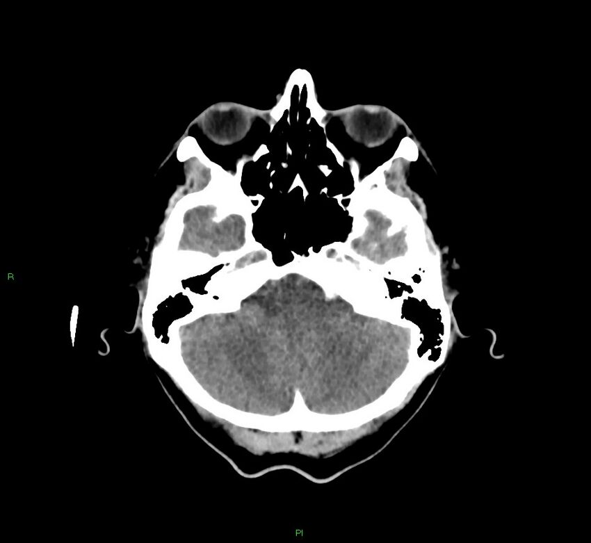 Cerebral amyloid angiopathy-associated lobar intracerebral hemorrhage (Radiopaedia 58756-65977 Axial non-contrast 42).jpg