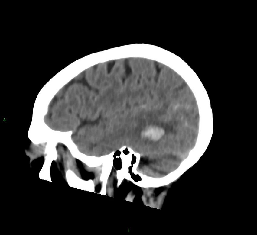 Cerebral amyloid angiopathy-associated lobar intracerebral hemorrhage (Radiopaedia 58757-65978 C 42).jpg