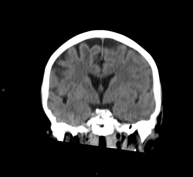 File:Cerebral amyloid angiopathy-associated lobar intracerebral hemorrhage (Radiopaedia 58757-65978 Coronal non-contrast 39).jpg