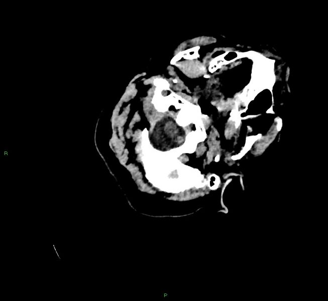 File:Cerebral amyloid angiopathy-associated lobar intracerebral hemorrhage (Radiopaedia 58757-65979 Axial non-contrast 12).jpg
