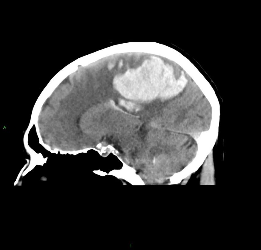 Cerebral amyloid angiopathy-associated lobar intracerebral hemorrhage (Radiopaedia 59356-66716 C 25).jpg