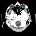 Cerebral and orbital tuberculomas (Radiopaedia 13308-13310 B 5).jpg