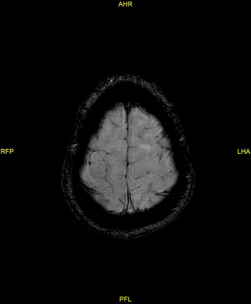File:Cerebral autosomal dominant arteriopathy with subcortical infarcts and leukoencephalopathy (CADASIL) (Radiopaedia 86108-102054 Axial SWI 95).jpg