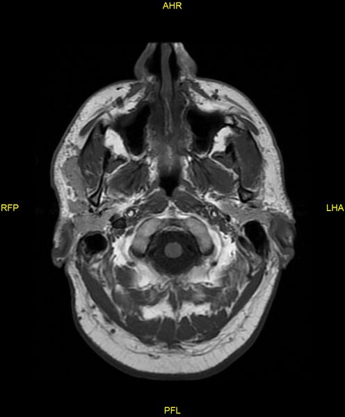 File:Cerebral autosomal dominant arteriopathy with subcortical infarcts and leukoencephalopathy (CADASIL) (Radiopaedia 86108-102054 Axial T1 2).jpg
