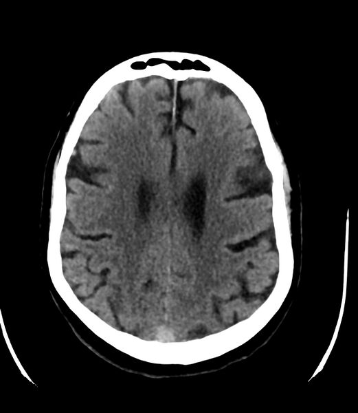 File:Cerebral dural venous sinus thrombosis (Radiopaedia 86514-102575 Axial non-contrast 30).jpg