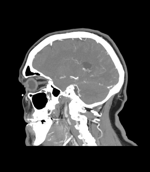 File:Cerebral dural venous sinus thrombosis (Radiopaedia 86514-102576 C 17).jpg