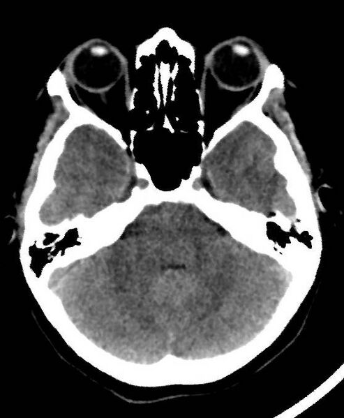 File:Cerebral edema due to severe hyponatremia (Radiopaedia 89826-106937 Axial non-contrast 24).jpg