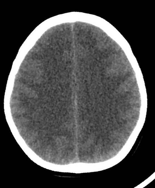 File:Cerebral edema due to severe hyponatremia (Radiopaedia 89826-106937 Axial non-contrast 61).jpg