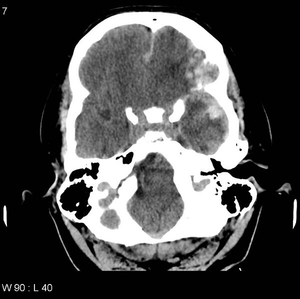 File:Cerebral hemorrhagic contusion with subdural and subarachnoid hemorrhage (Radiopaedia 10680-19197 Axial non-contrast 3).jpg