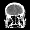 Cerebral hemorrhagic contusions (Radiopaedia 23145-23188 Coronal non-contrast 13).jpg