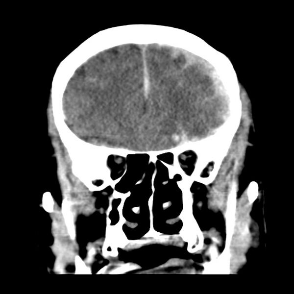 File:Cerebral hemorrhagic contusions (Radiopaedia 23145-23188 Coronal non-contrast 13).jpg