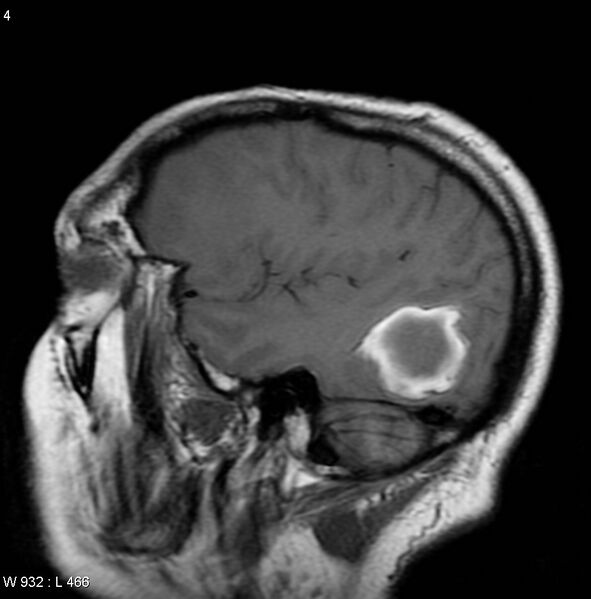 File:Cerebral metastases - renal cell carcinoma (Radiopaedia 5510-7246 Sagittal T1 1).jpg
