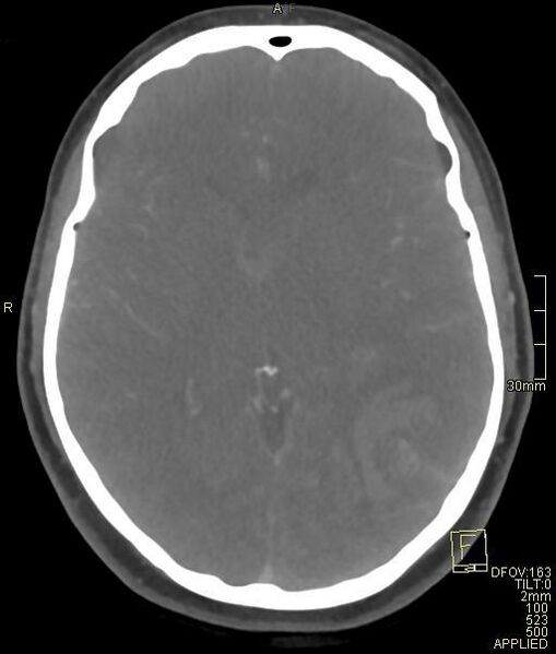 File:Cerebral venous sinus thrombosis (Radiopaedia 91329-108965 Axial venogram 42).jpg