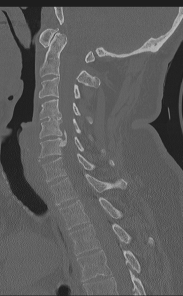 File:Cervical canal stenosis - OPLL and osteophytes (Radiopaedia 47329-51910 Sagittal bone window 35).png