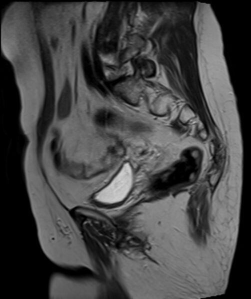 File:Cervical carcinoma (Radiopaedia 88312-104943 Sagittal T2 12).jpg