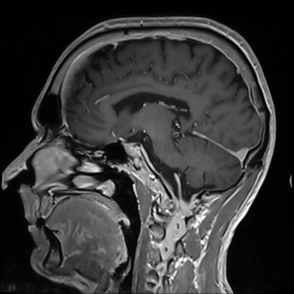 File:Cervical dural CSF leak on MRI and CT treated by blood patch (Radiopaedia 49748-54995 G 48).jpg