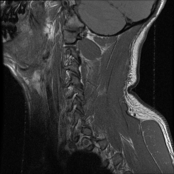 File:Cervical flexion teardrop fracture with cord hemorrhage (Radiopaedia 32497-33455 Sagittal T1 17).jpg