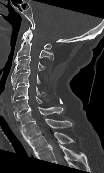 File:Cervical spine fracture - chalk stick (Radiopaedia 39116-41323 Sagittal bone window 29).png