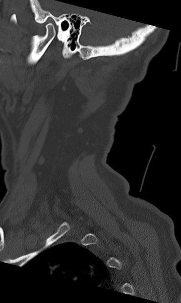 File:Cervical spine fracture - chalk stick (Radiopaedia 39116-41323 Sagittal bone window 56).png