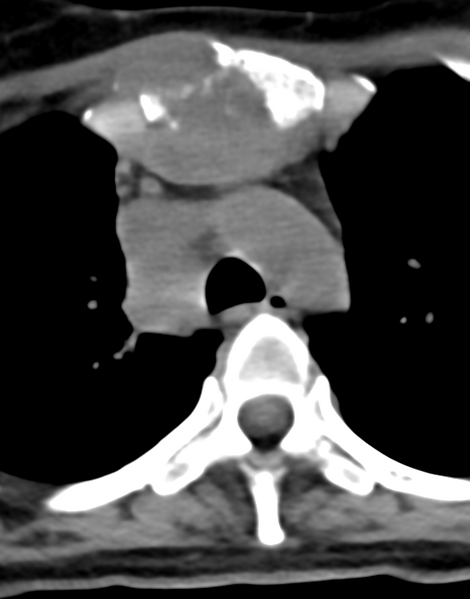 File:Cervical tuberculous spondylitis (Radiopaedia 39149-41365 Axial non-contrast 60).png