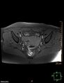 Cesarian scar endometriosis (Radiopaedia 68495-78066 Axial T1 fat sat 13).jpg