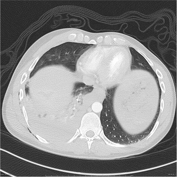 File:Chest and abdomen multi-trauma (Radiopaedia 26294-26425 lung window 80).jpg