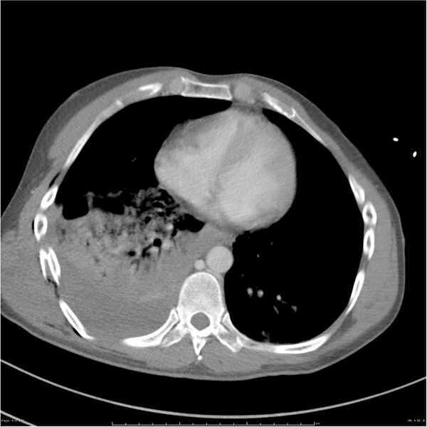 File:Chest and abdomen multi-trauma (Radiopaedia 26294-26426 bone window 4).jpg