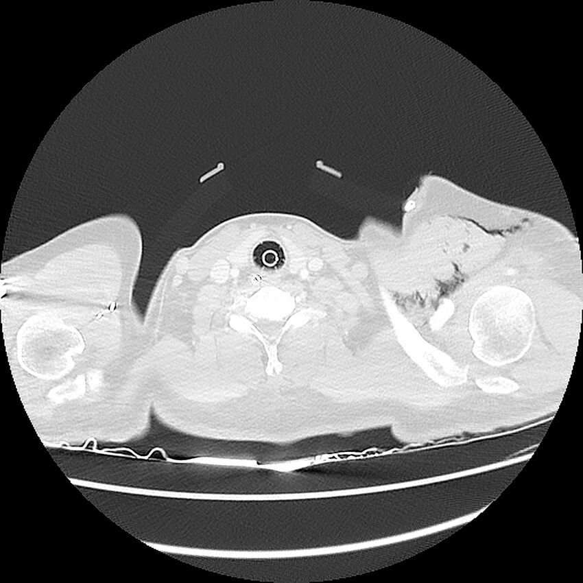 Chest crush injury (Radiopaedia 31620-32513 Axial lung window 1).jpg