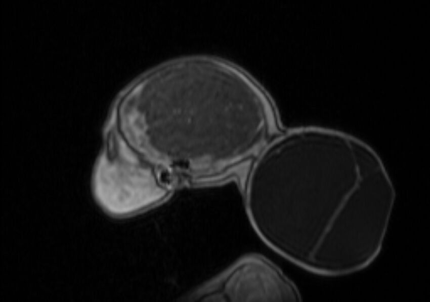 Chiari III malformation with occipital encephalocele (Radiopaedia 79446-92559 Sagittal T1 C+ mpr 16).jpg