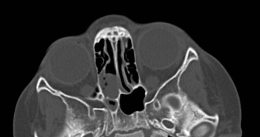 Choanal atresia (Radiopaedia 51295-56972 Axial bone window 40).jpg