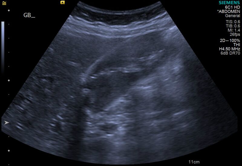 File:Cholelithiasis with biliary dilatation (Radiopaedia 49442-54588 A 8).jpg