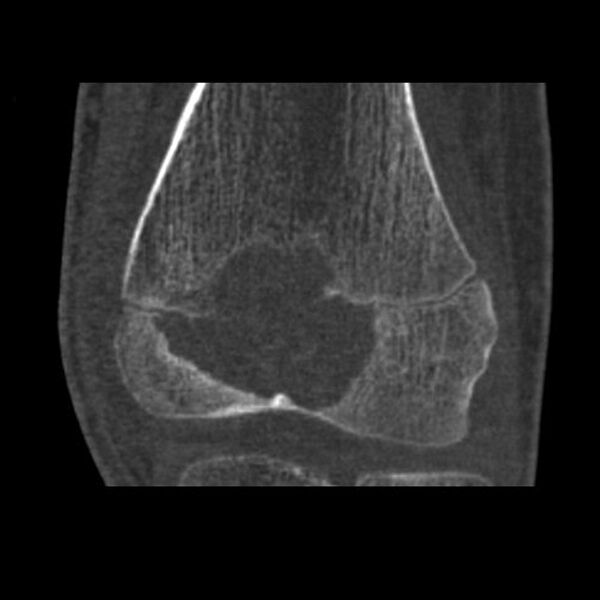 File:Chondroblastoma - distal femur (Radiopaedia 8112-8950 Coronal bone window 1).jpg