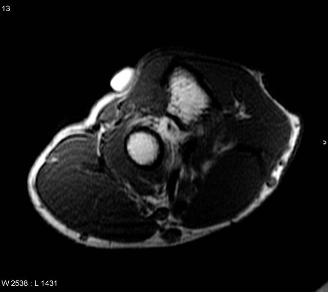 File:Chondromyxoid fibroma (Radiopaedia 6172-7626 Axial T1 1).jpg